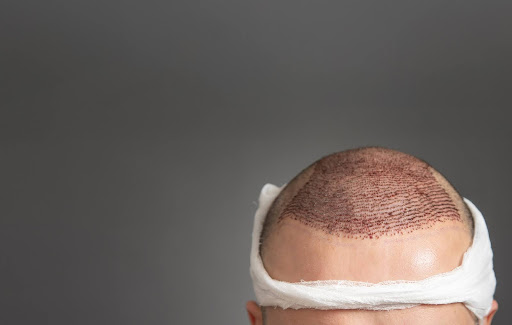 أفضل ثلاث مراكز زراعة شعر في الإمارات